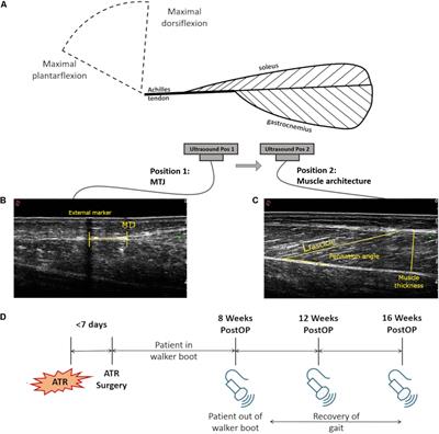 Muscle Fascicles Exhibit Limited Passive Elongation Throughout the Rehabilitation of <mark class="highlighted">Achilles Tendon Rupture</mark> After Percutaneous Repair